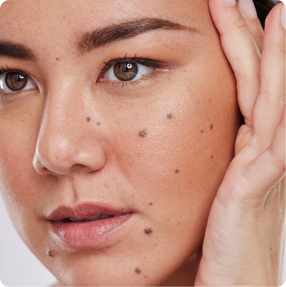 Person's face showing moles and skin spots on cheek and jawline