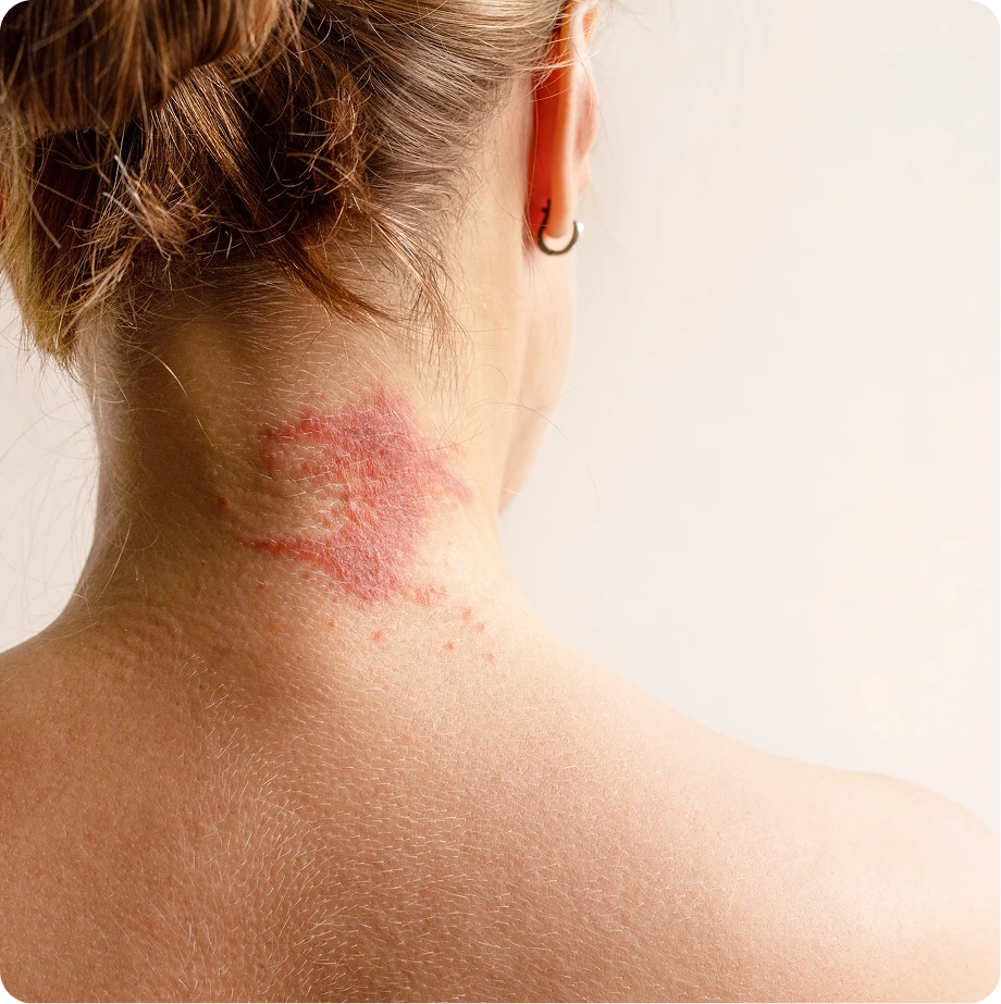 Person's neck and shoulder showing red rash patch