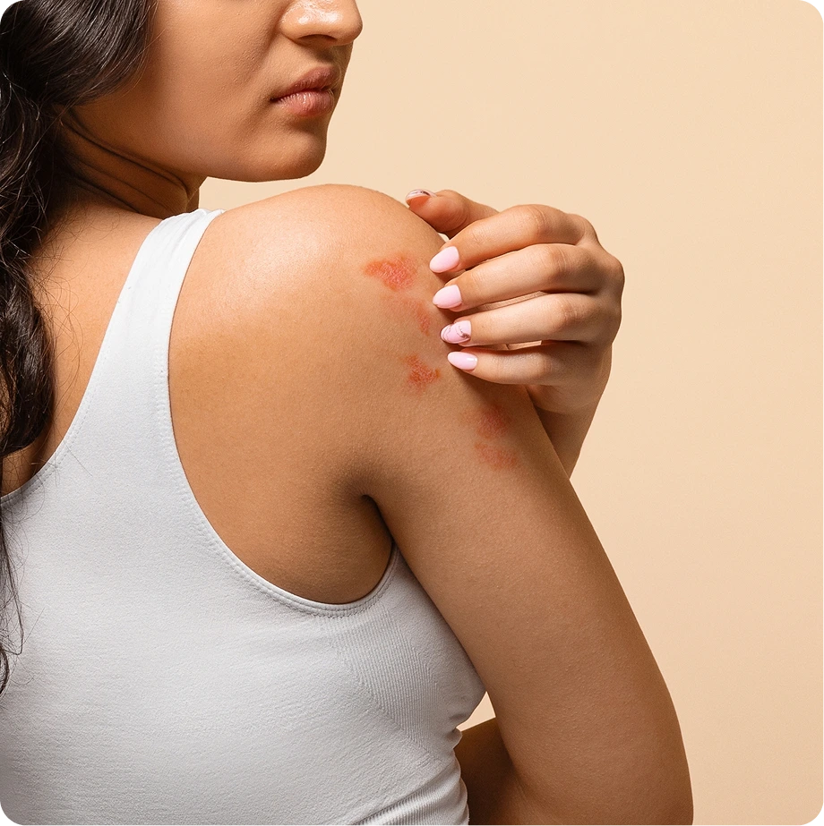 Woman pointing to inflamed skin on her shoulder showing eczema or dermatitis