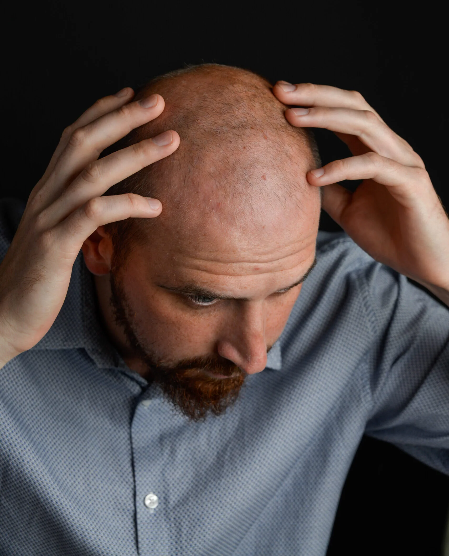 Man with male pattern baldness examining his scalp against a dark background