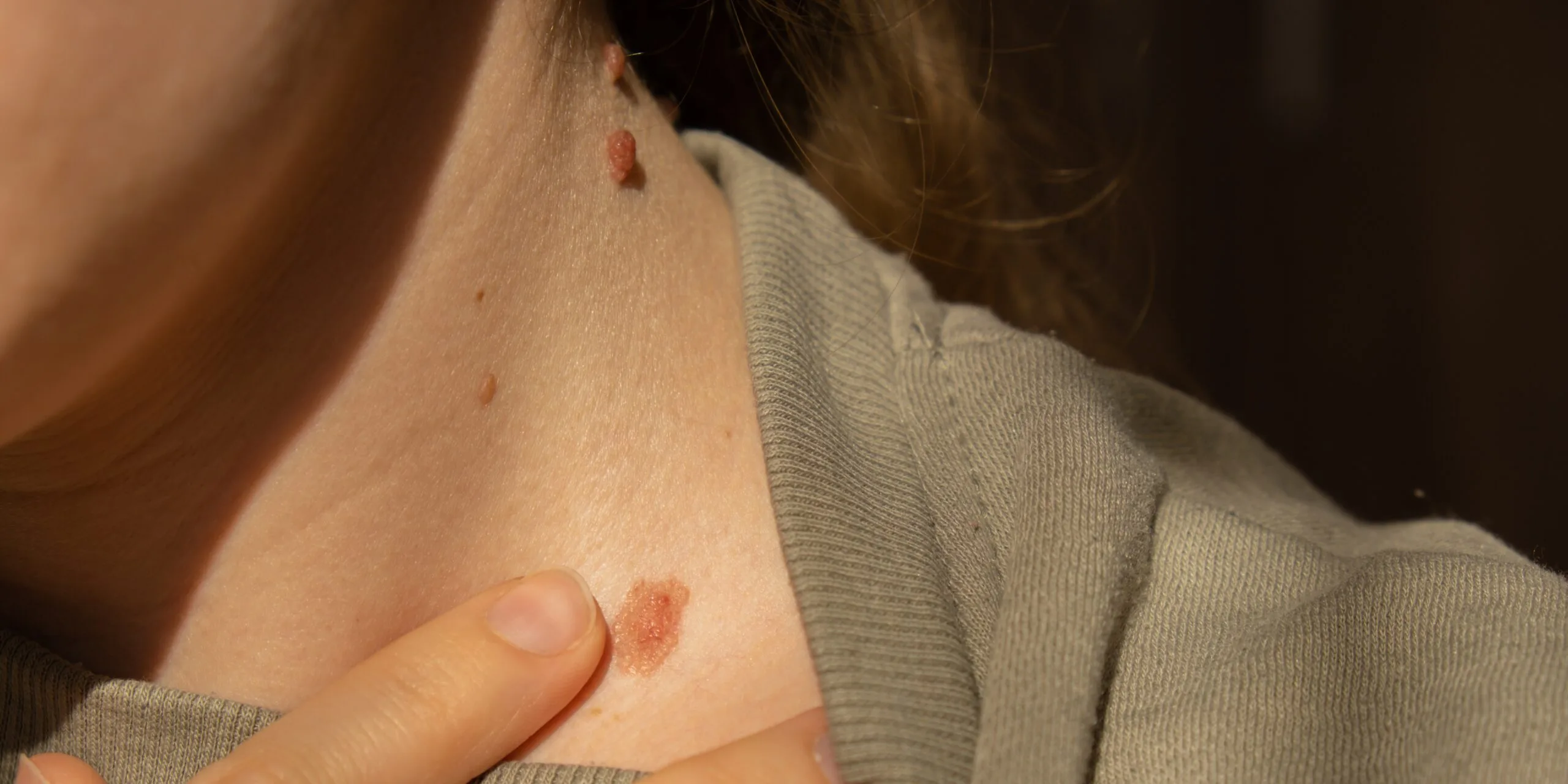 Close-up of a skin lesion on a patient's shoulder being examined during a melanoma screening