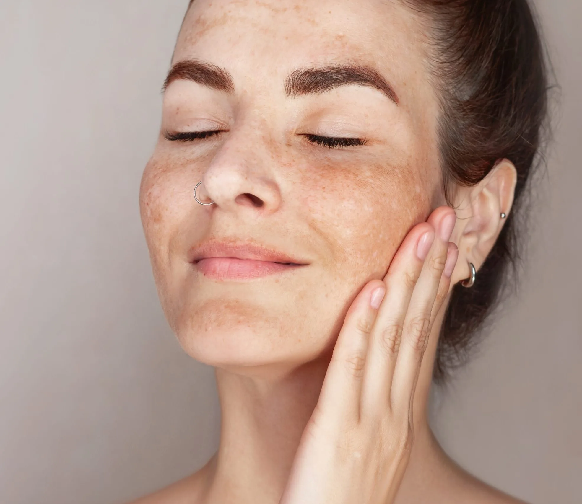 Woman's face showing melasma patches on cheeks and forehead