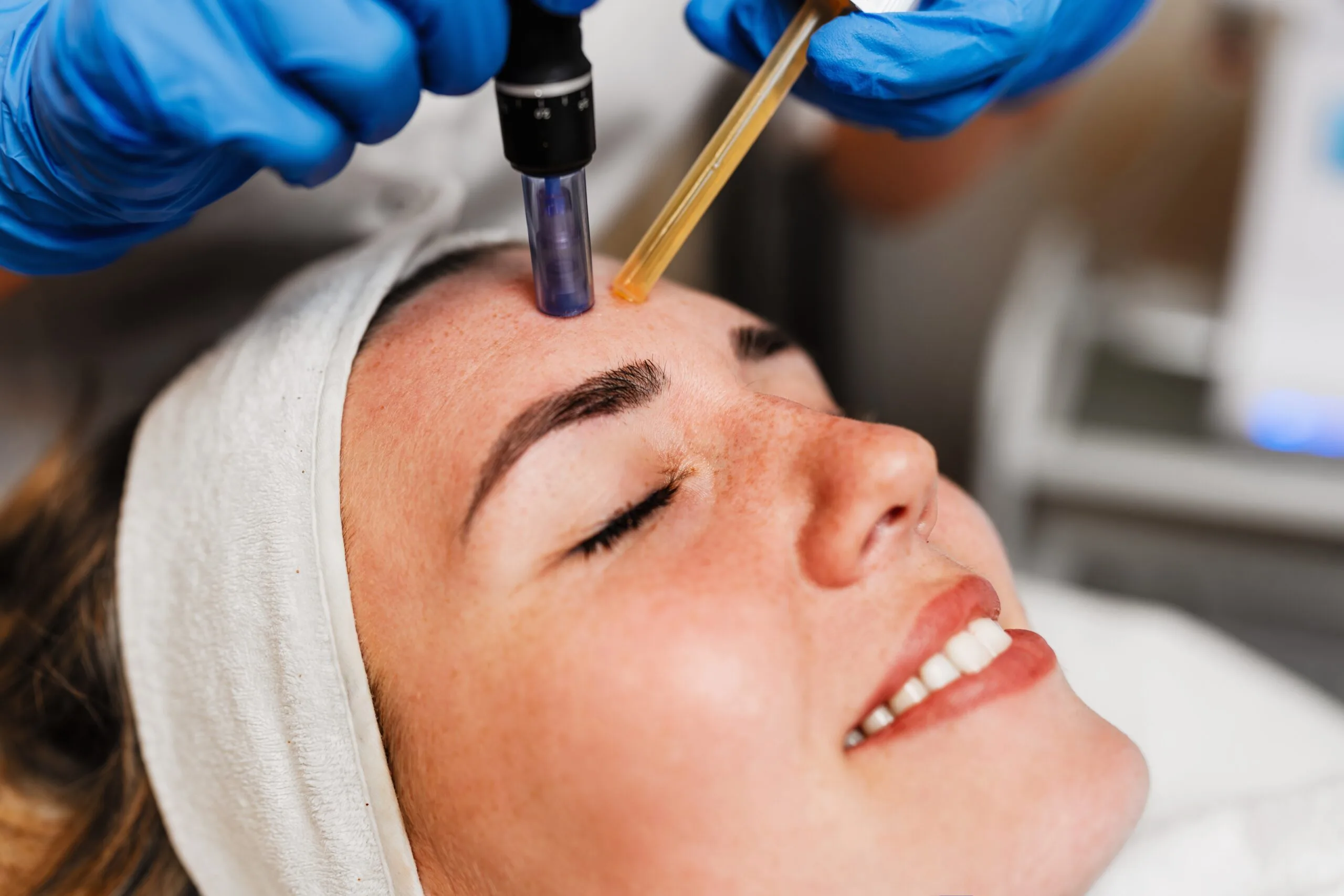 Clinician holding microneedling device and applicator over patient's forehead during treatment