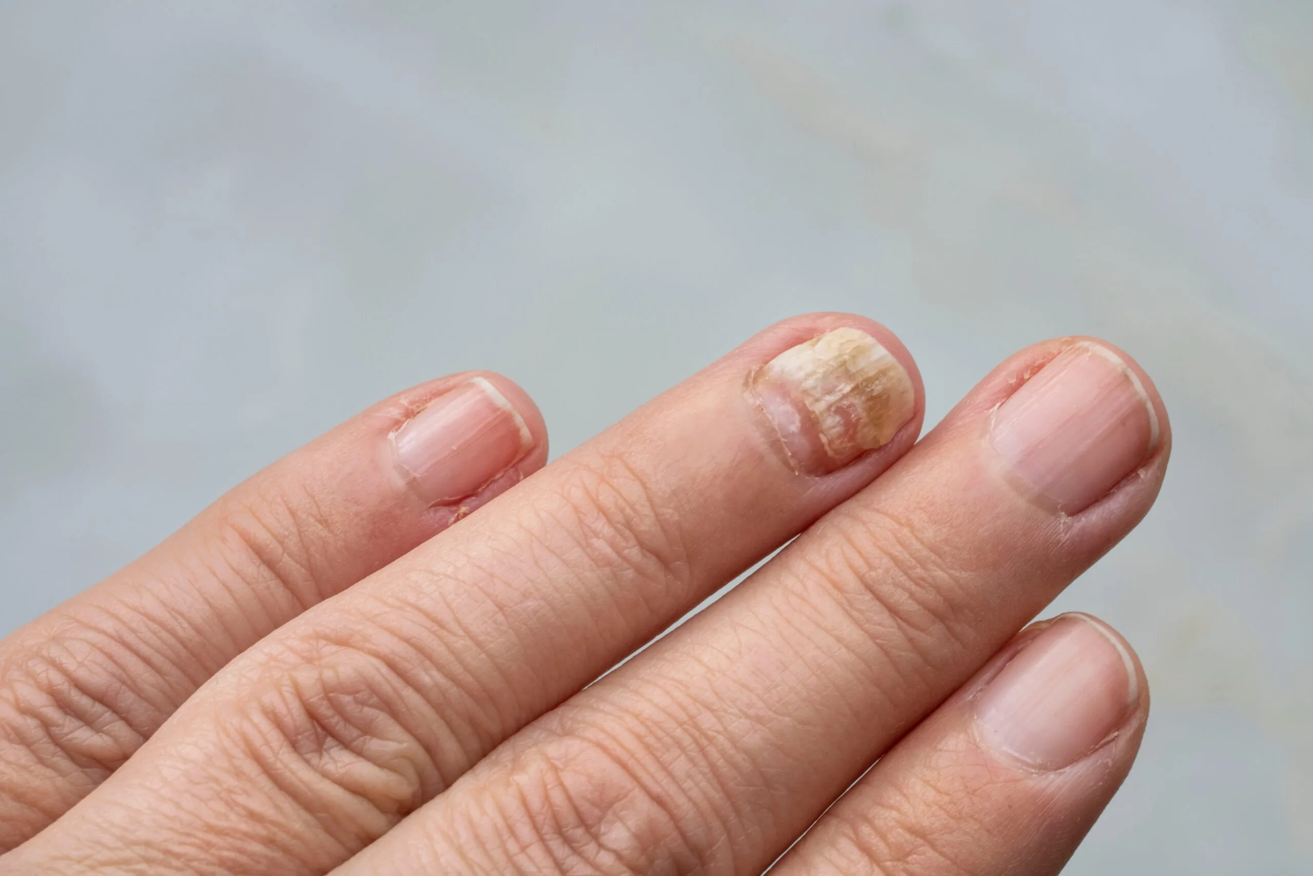 Fingernails showing fungal infection with discoloration and debris on one nail