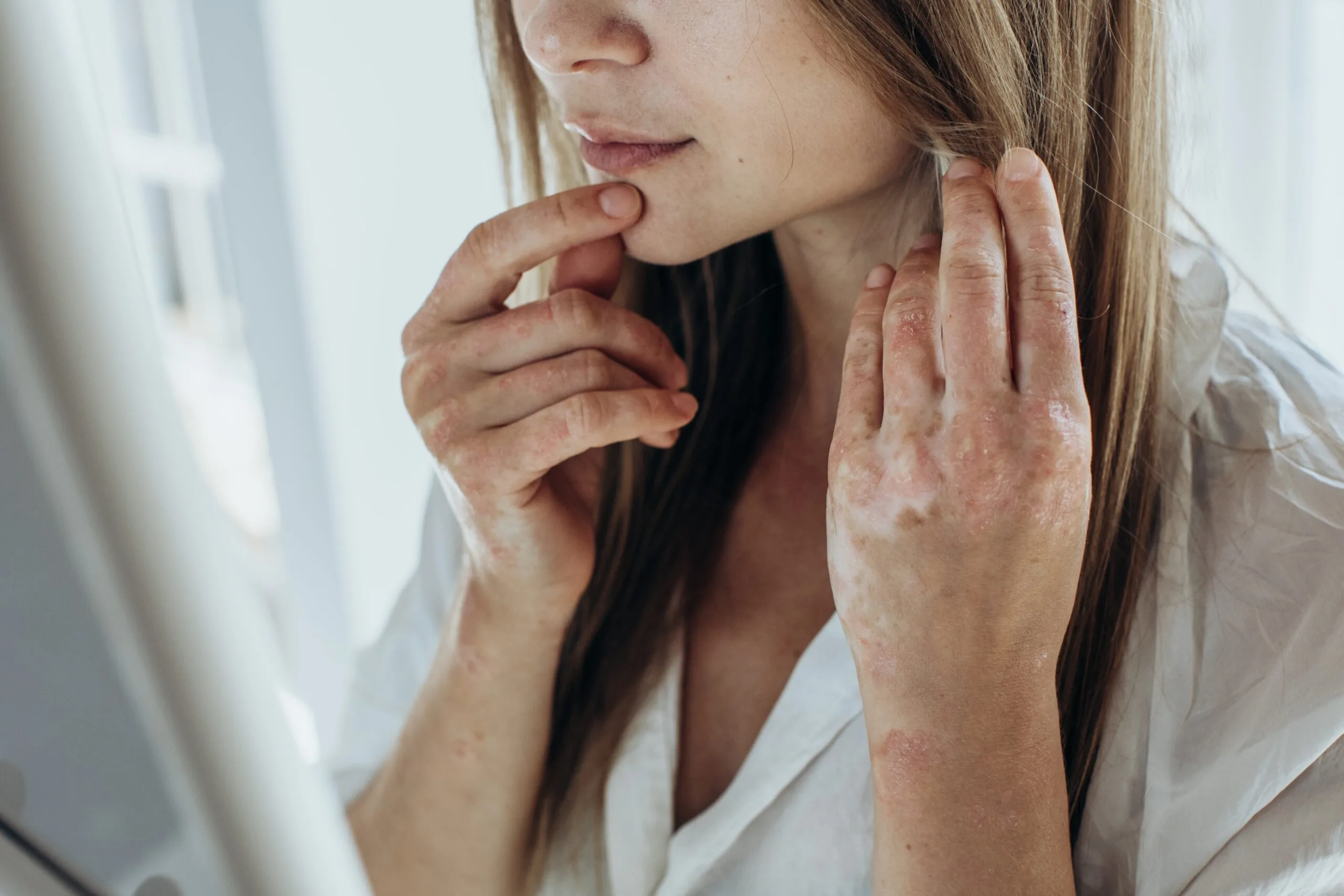 Woman examining psoriasis patches on her neck and chest