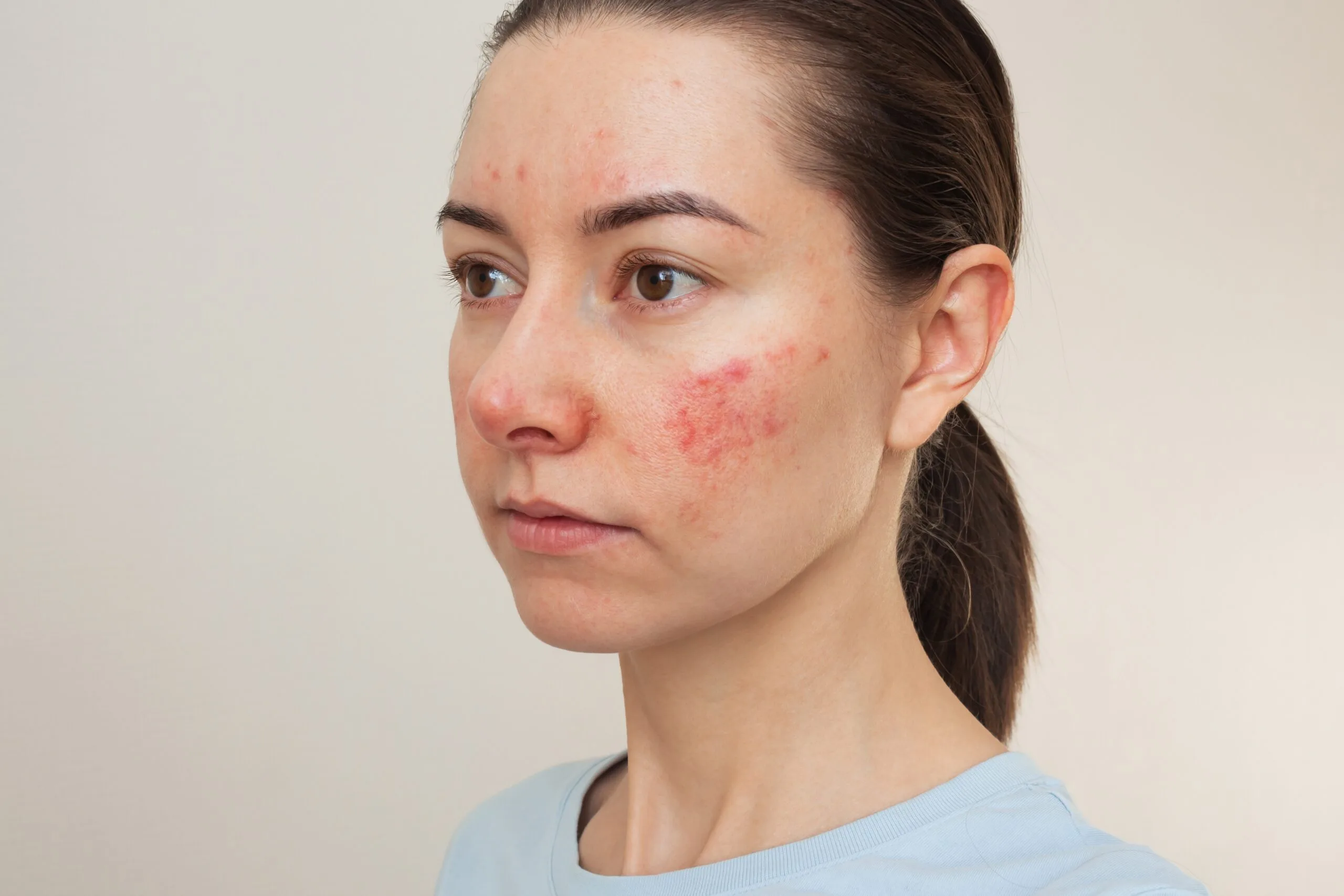 Person showing rosacea with facial redness and visible bumps on cheeks and forehead