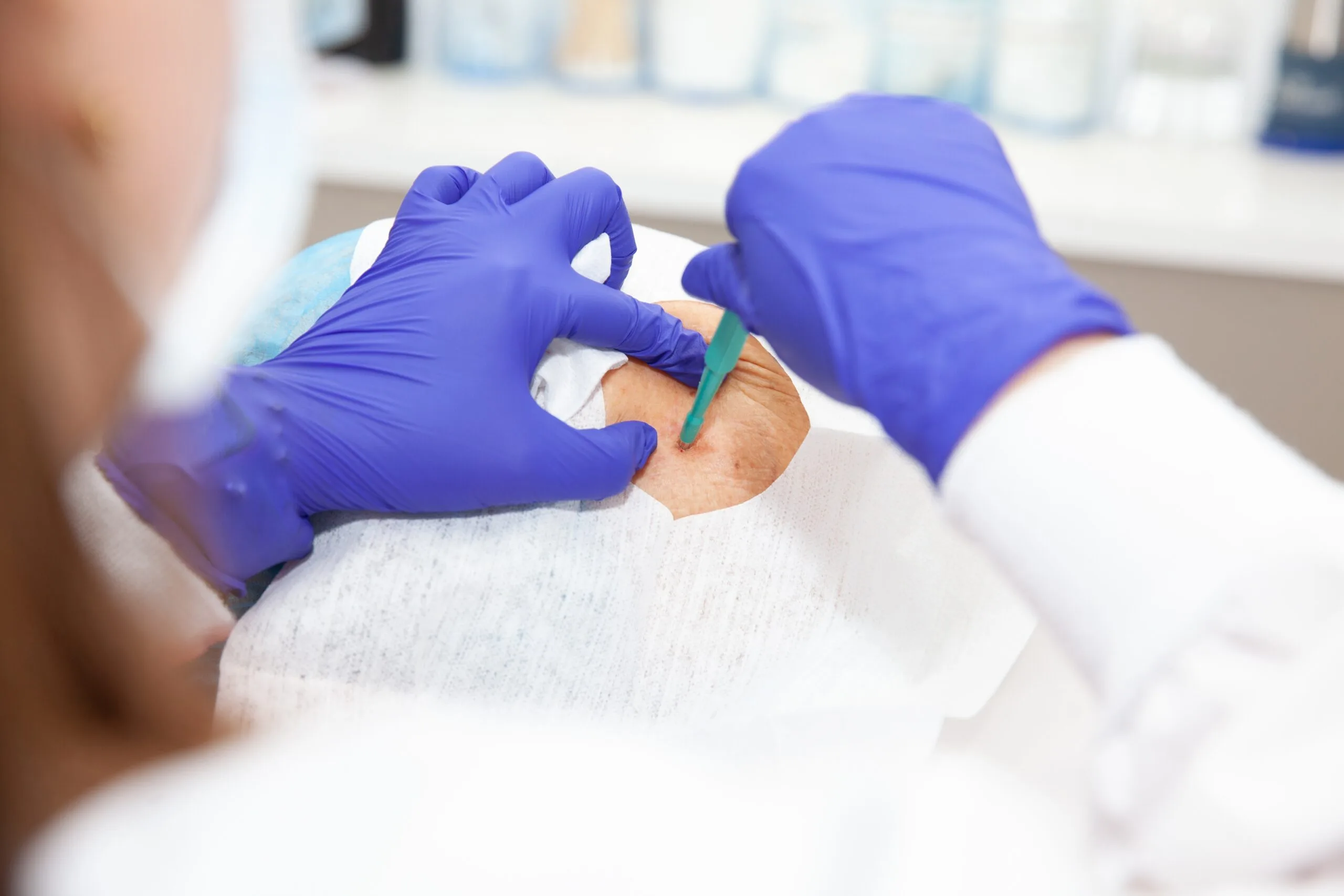 Dermatologist in purple gloves collecting a skin biopsy sample from a patient's arm in a clinical setting
