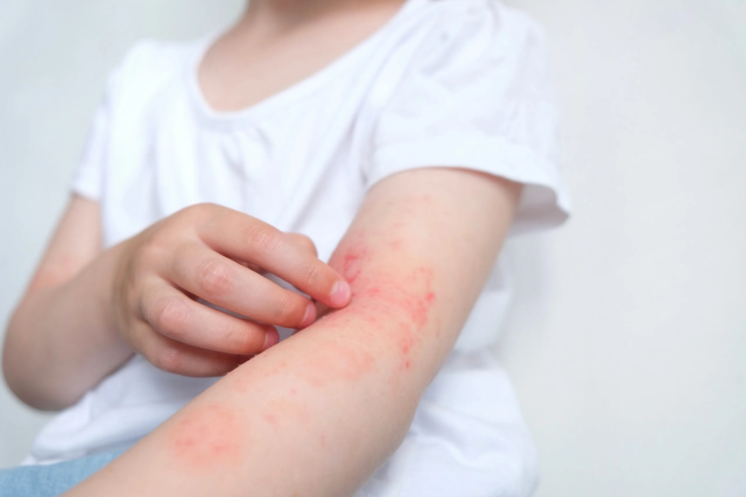 Child's arm showing a red, irritated skin rash while scratching it