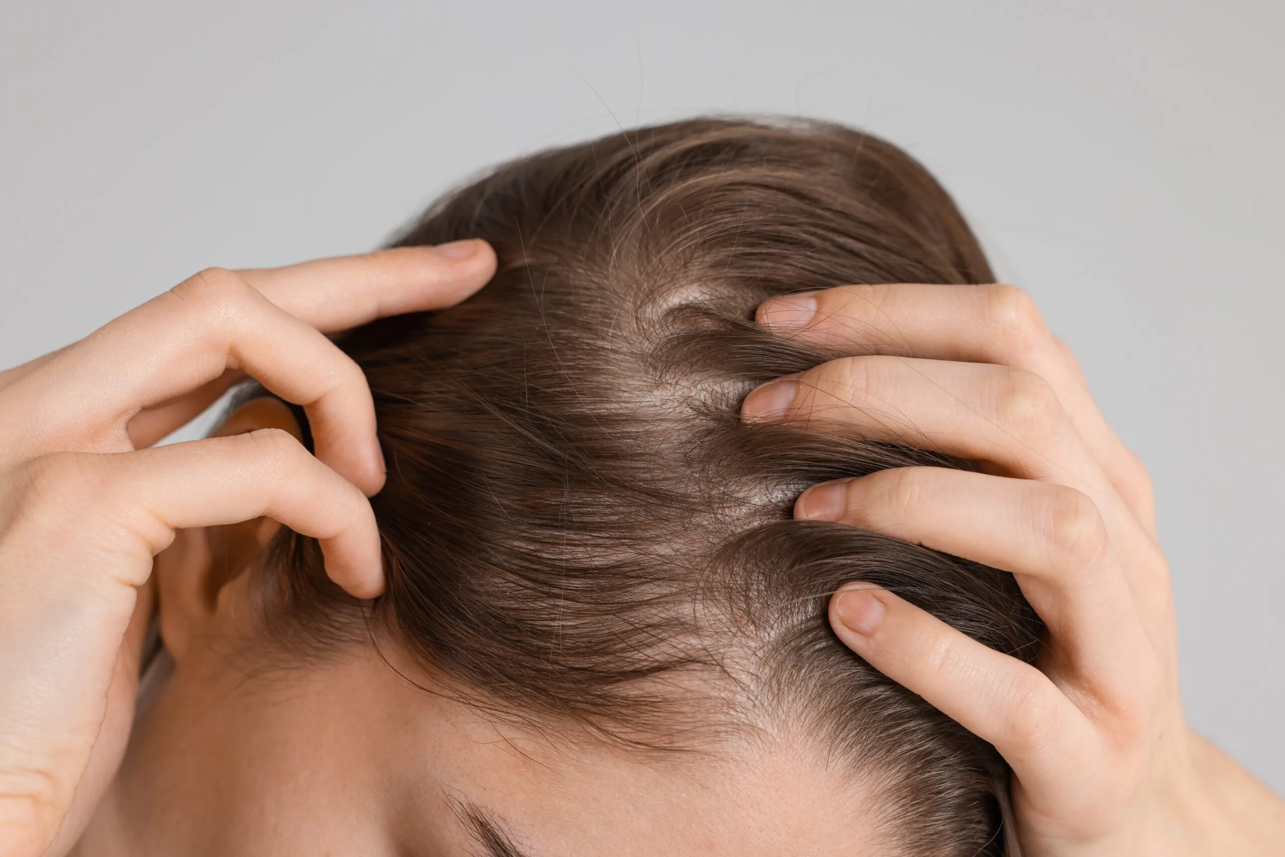 Person's hands examining their scalp showing thinning hair and visible scalp area