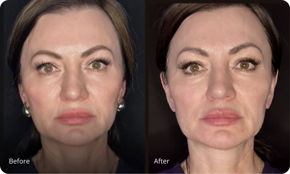 Sofwave before and after showing reduced facial wrinkles and improved skin texture