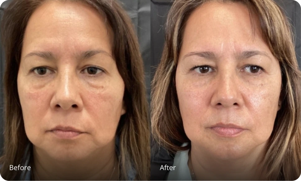 Sofwave before and after comparison showing facial skin texture improvement