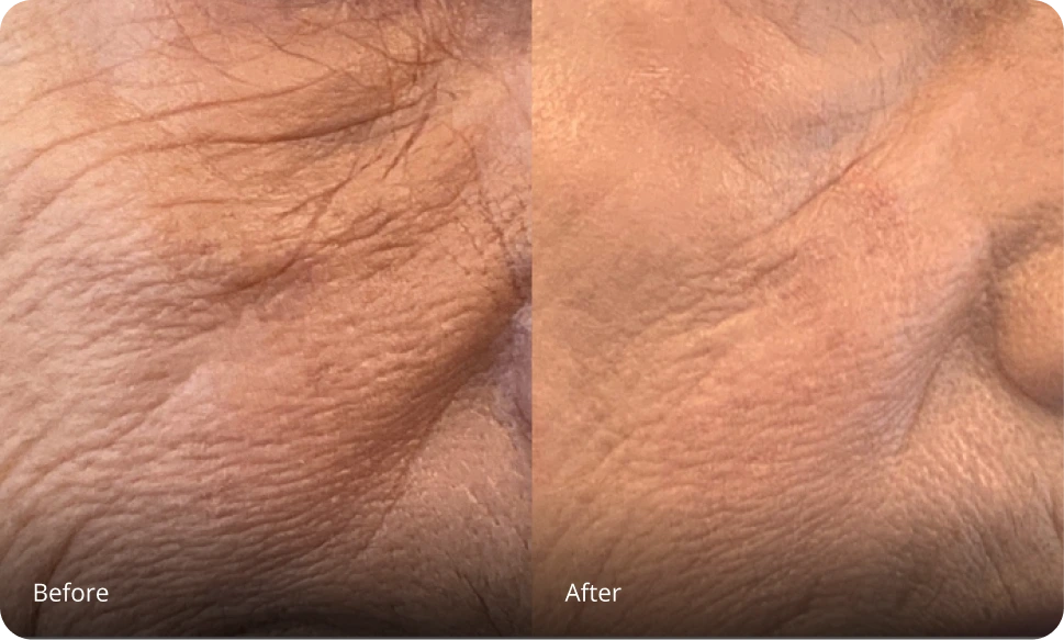 Before and after Sofwave treatment showing diminished chest wrinkles and improved skin texture