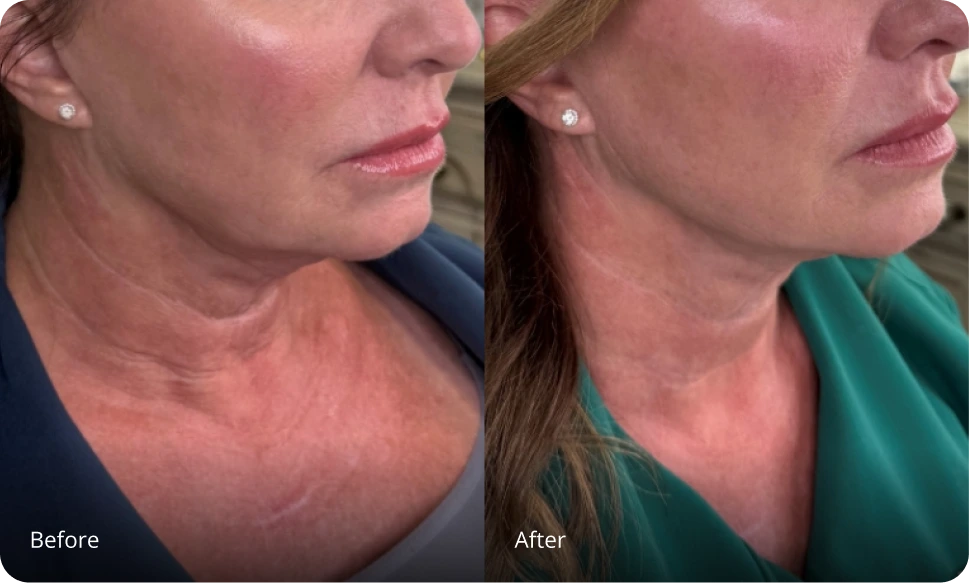 Before and after Sofwave treatment showing tighter skin and reduced neck and jawline wrinkles