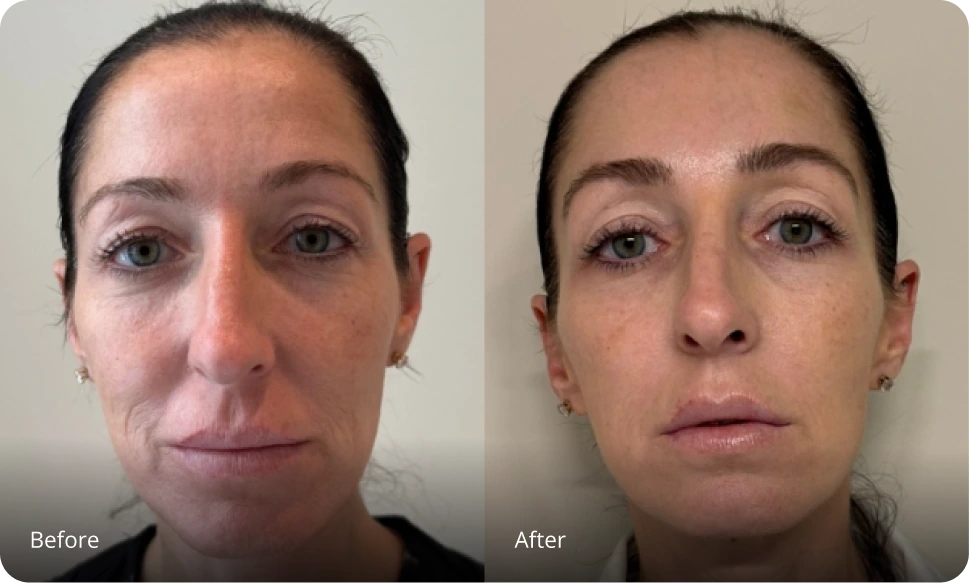 Before and after Sofwave treatment showing reduced facial wrinkles and improved skin firmness
