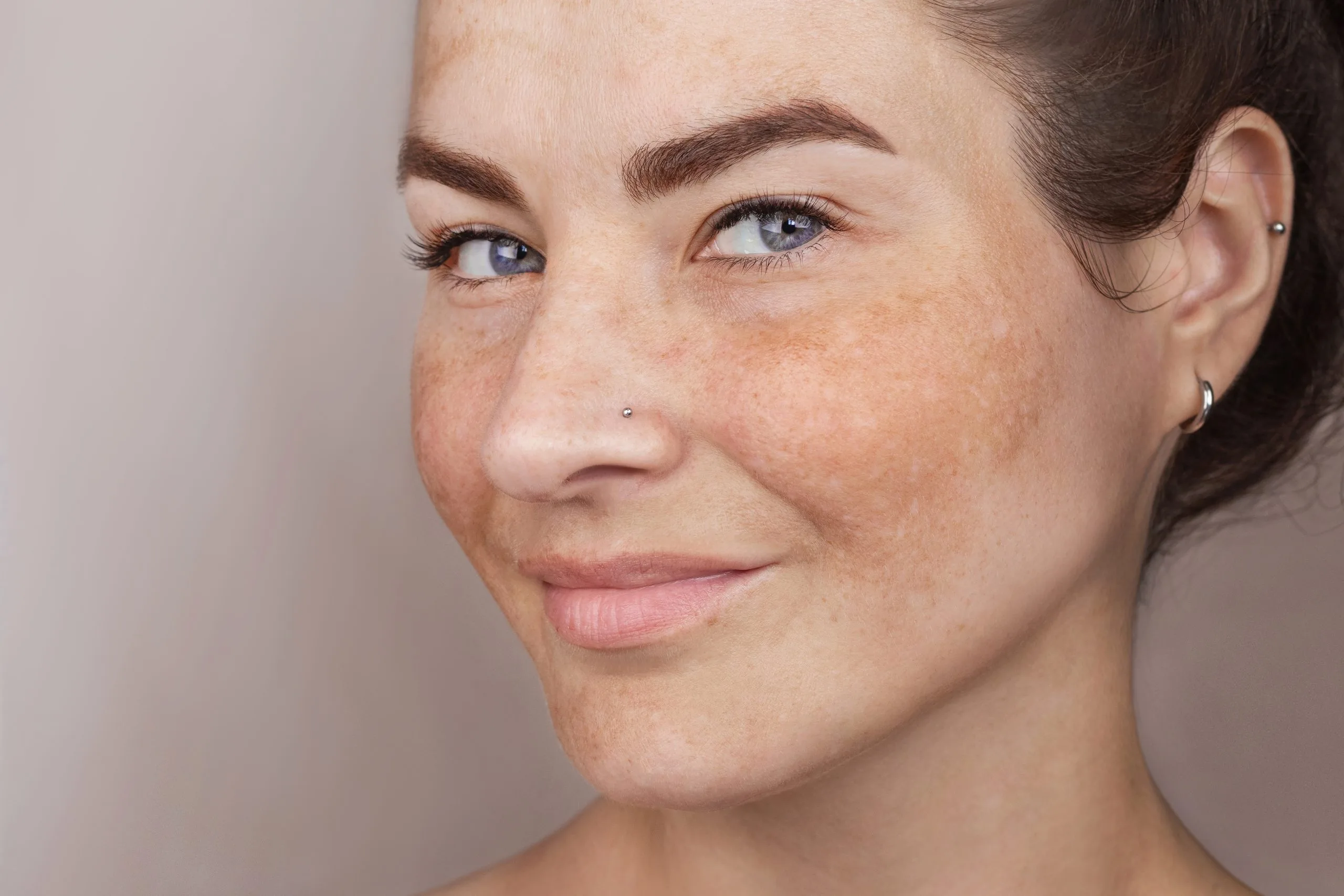 How to Get Rid of Melasma Banner