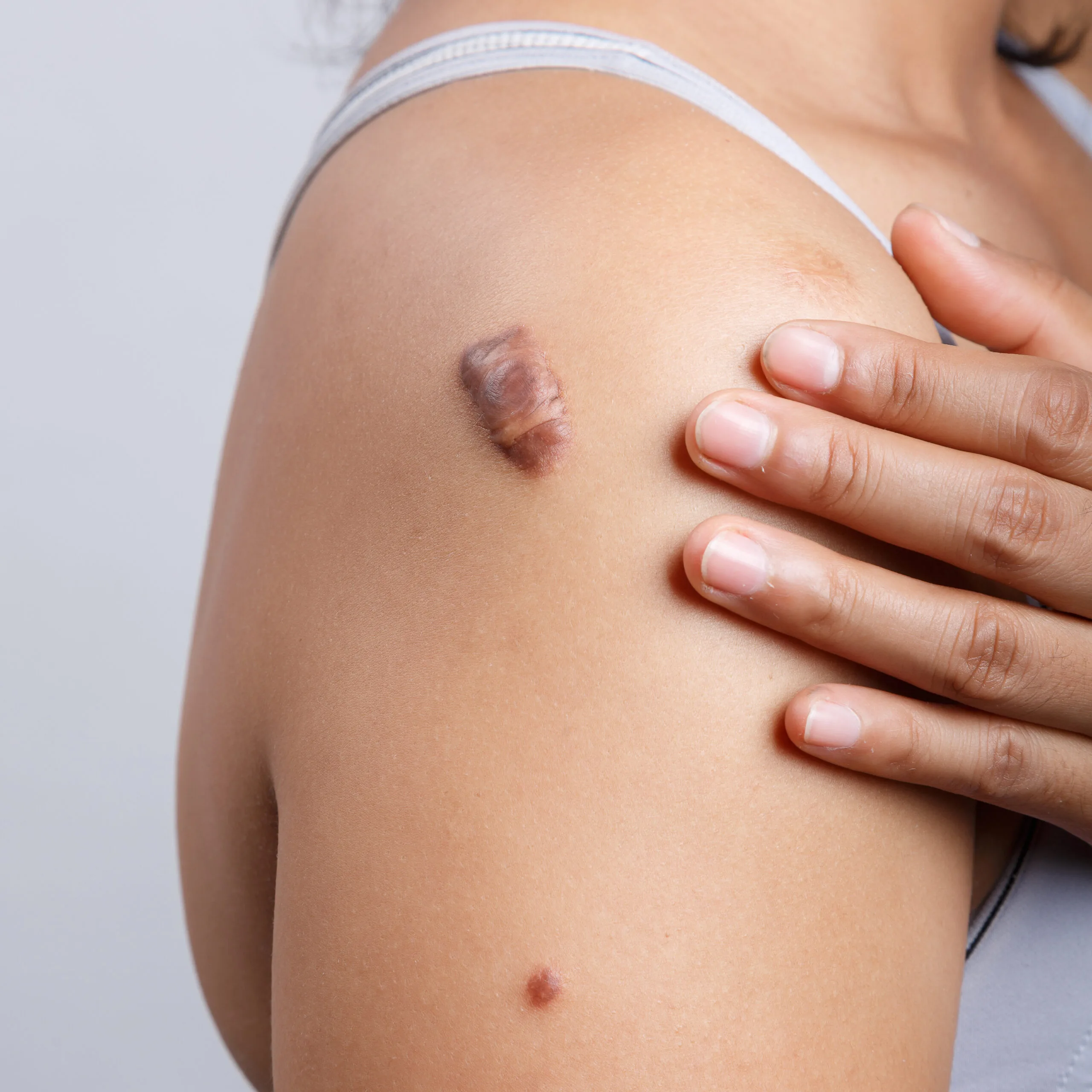 Person's shoulder with a raised, reddish-brown keloid scar being examined by a hand