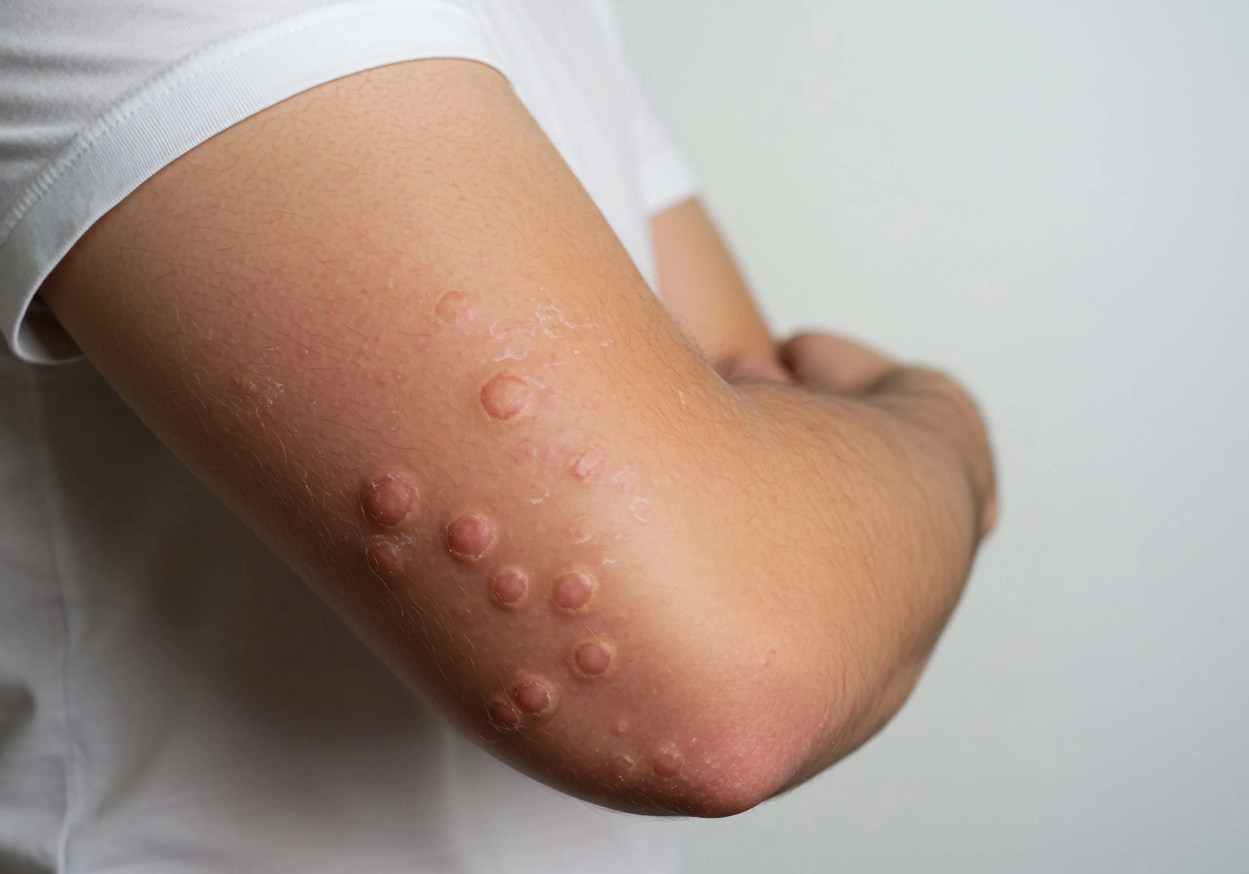Child's arm showing multiple small, firm, rounded skin-colored bumps characteristic of molluscum contagiosum