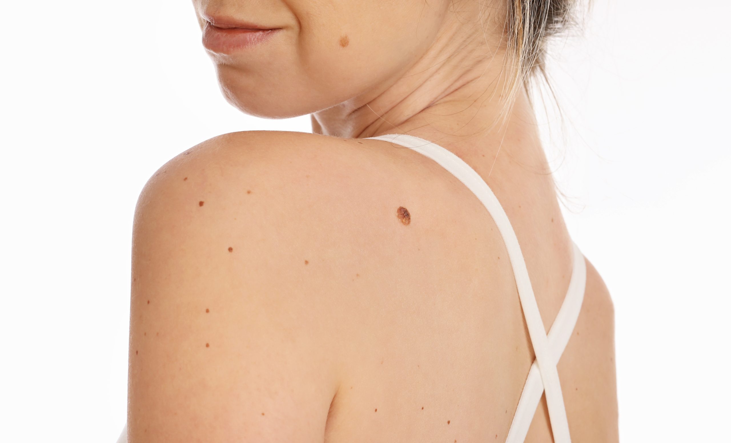 Person's back showing multiple small brown moles scattered across the skin