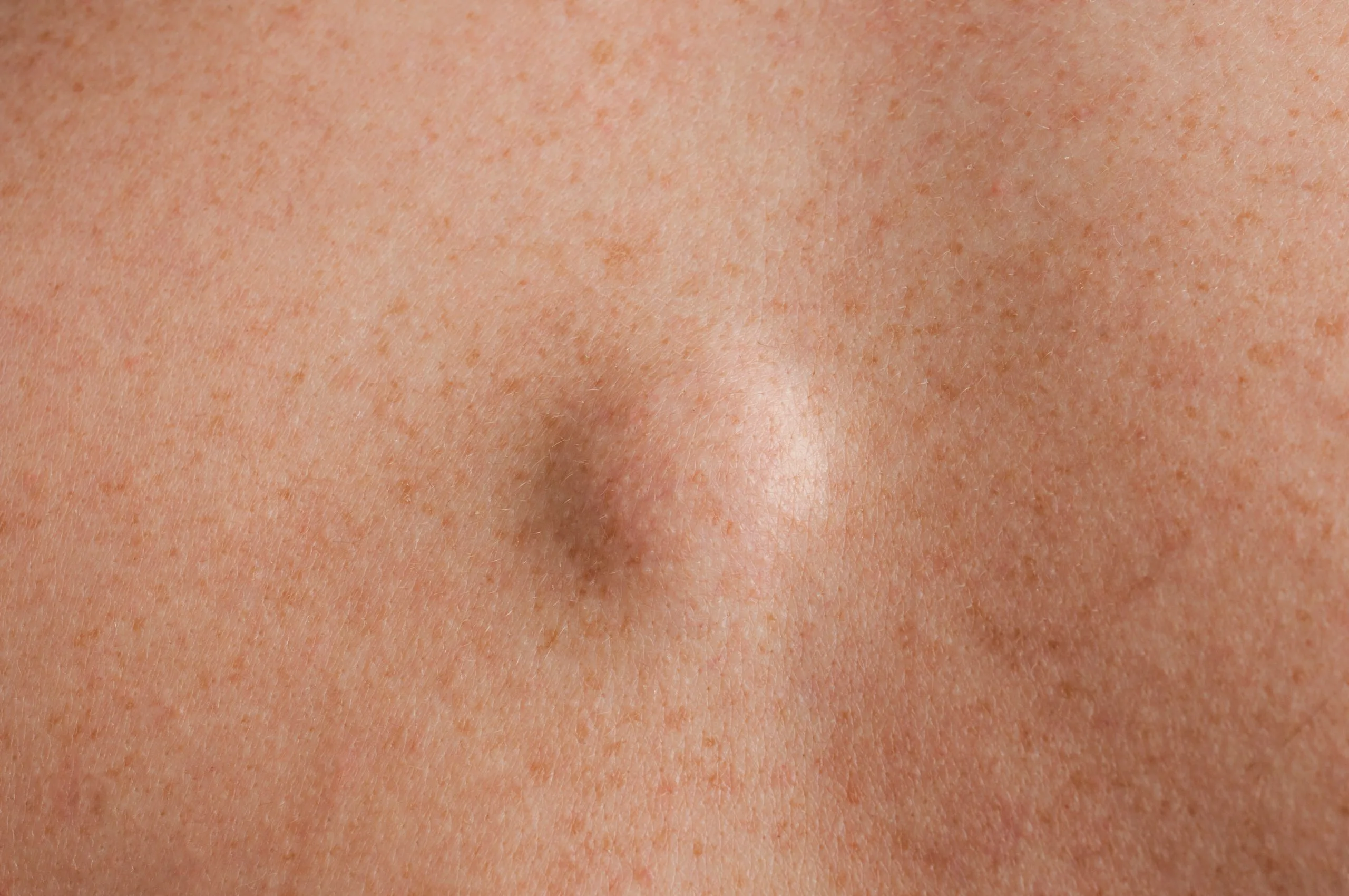 Lipoma, a small raised bump on skin with surrounding freckles