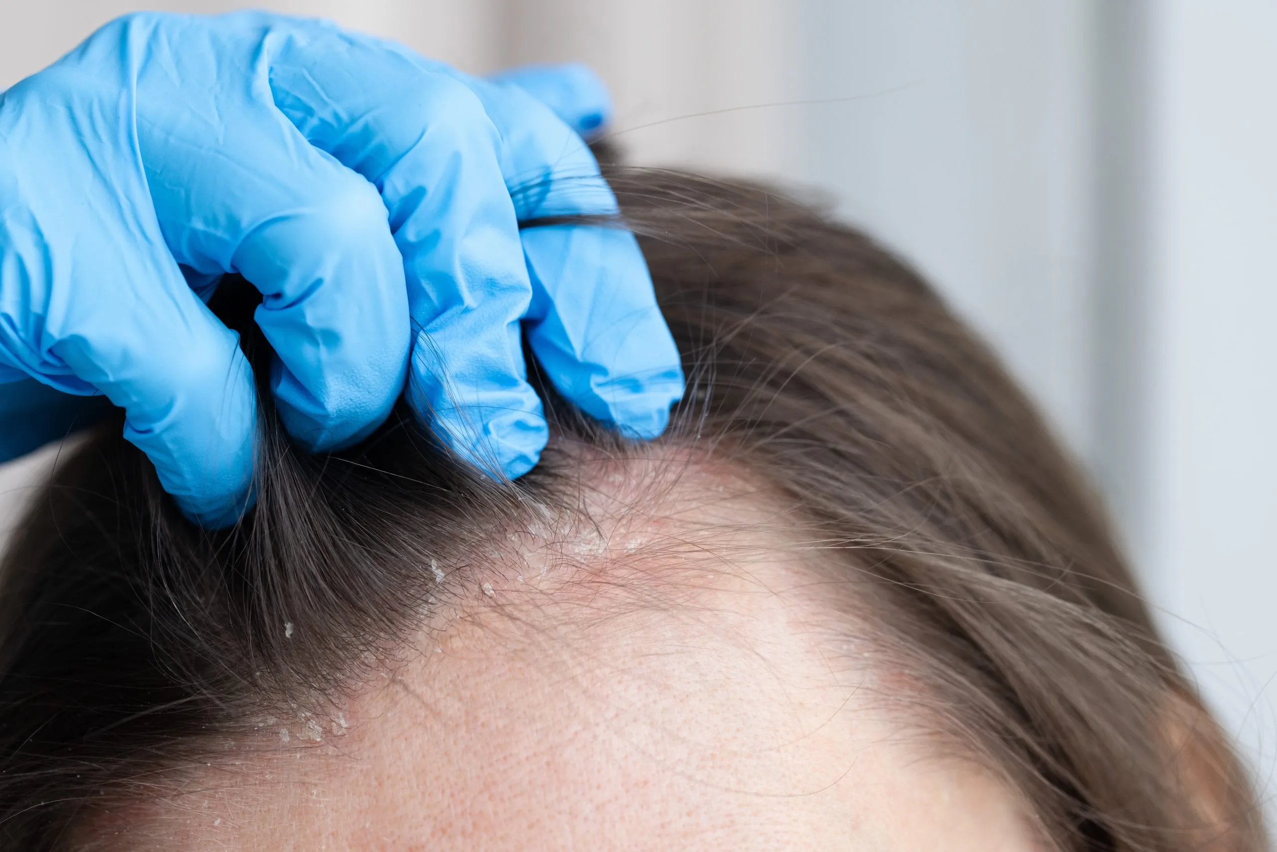 Gloved hand examining scalp for hair loss or skin condition