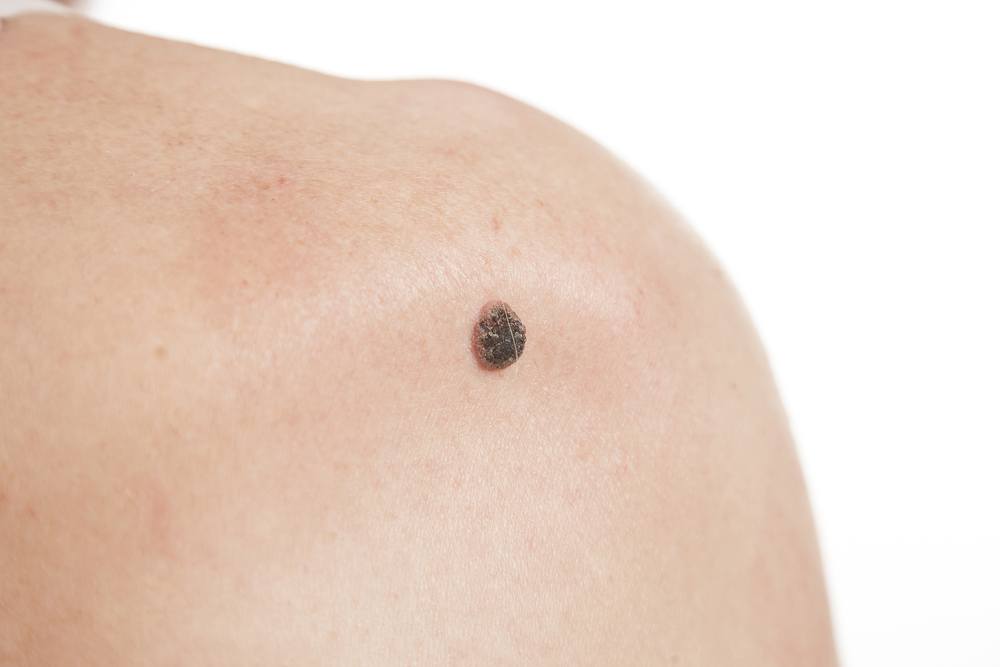 Dark mole on shoulder skin