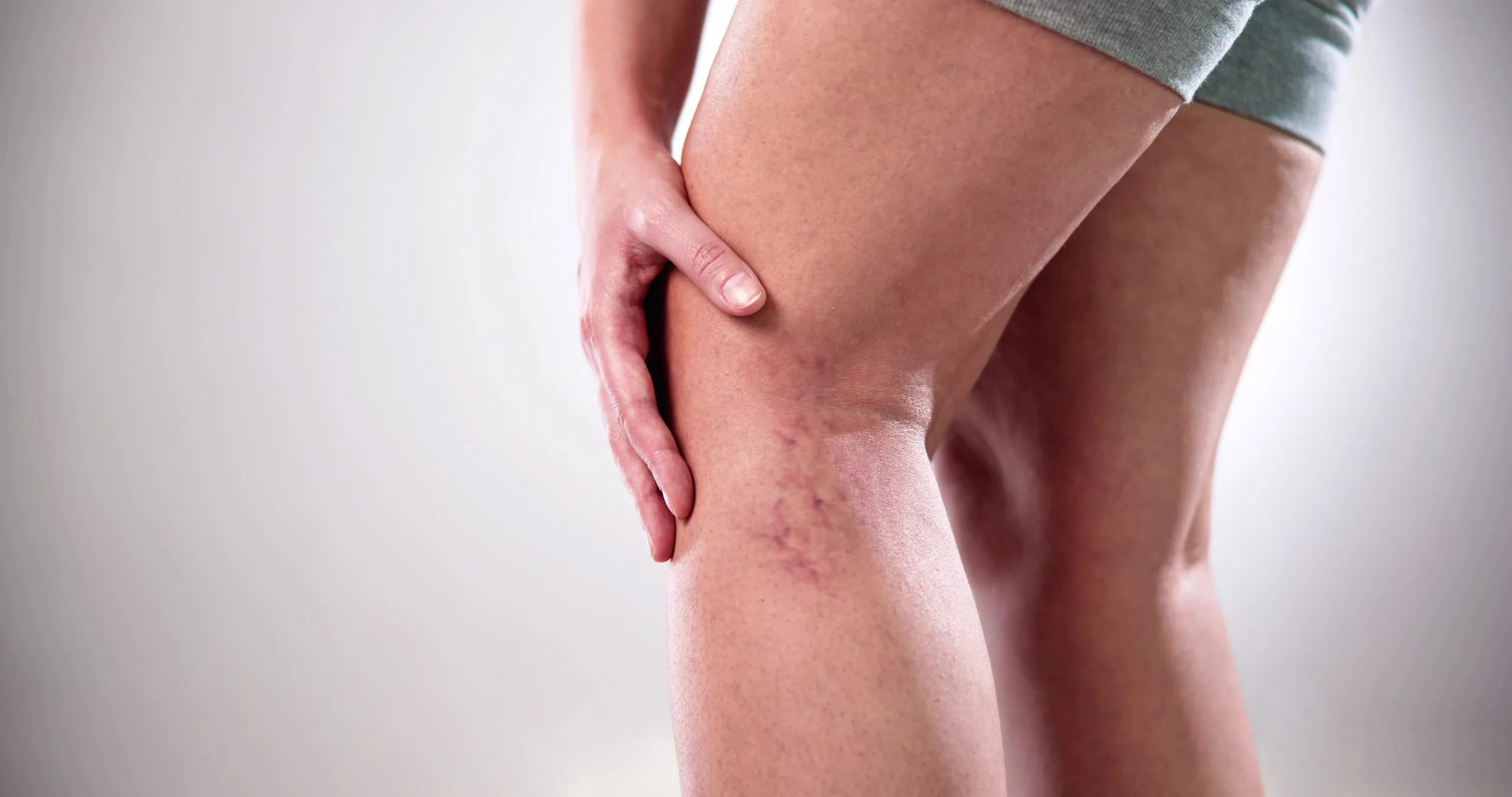 Person's leg showing red, patchy skin irritation on the thigh and knee area