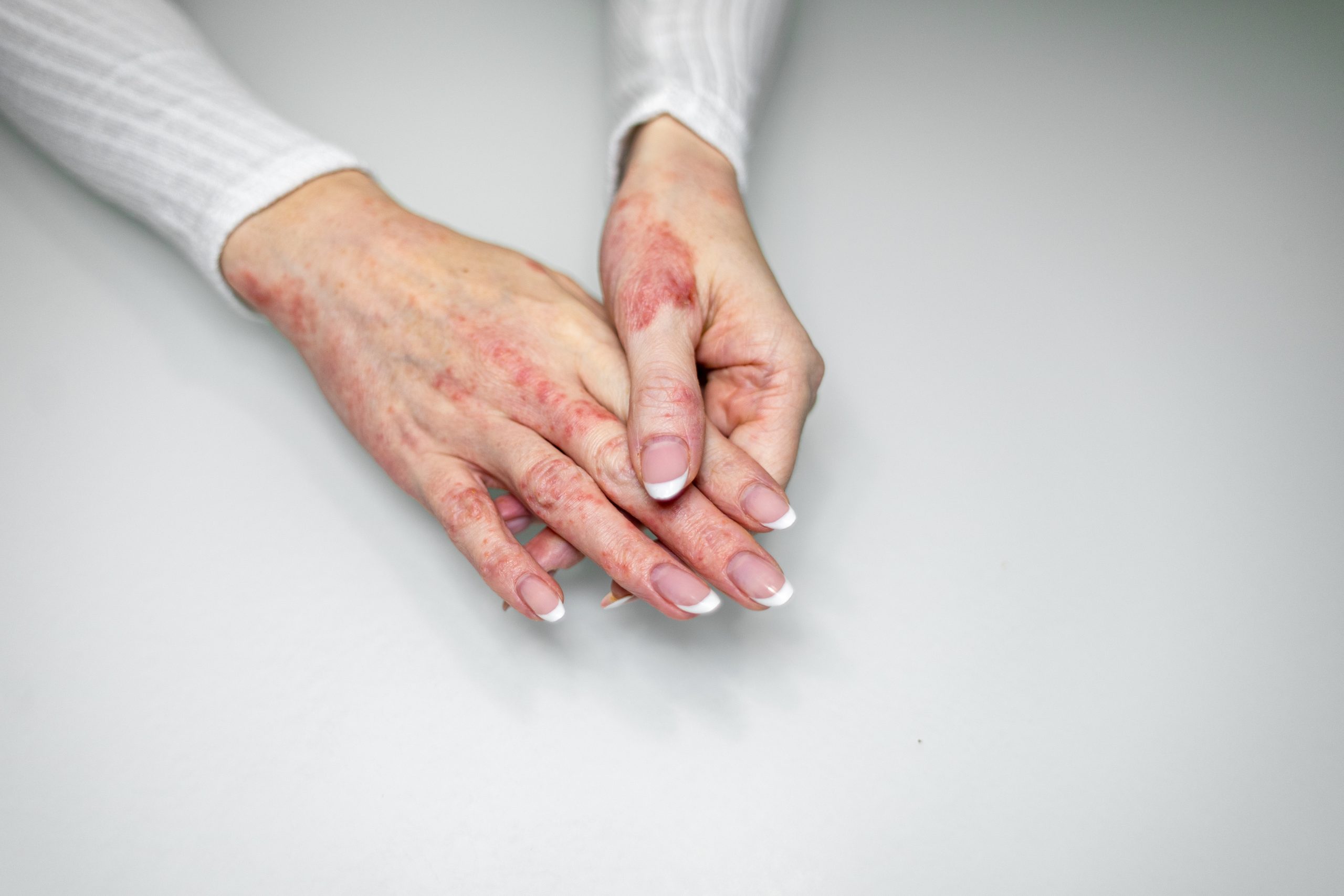 Hands showing red, irritated skin with rash on back and fingers