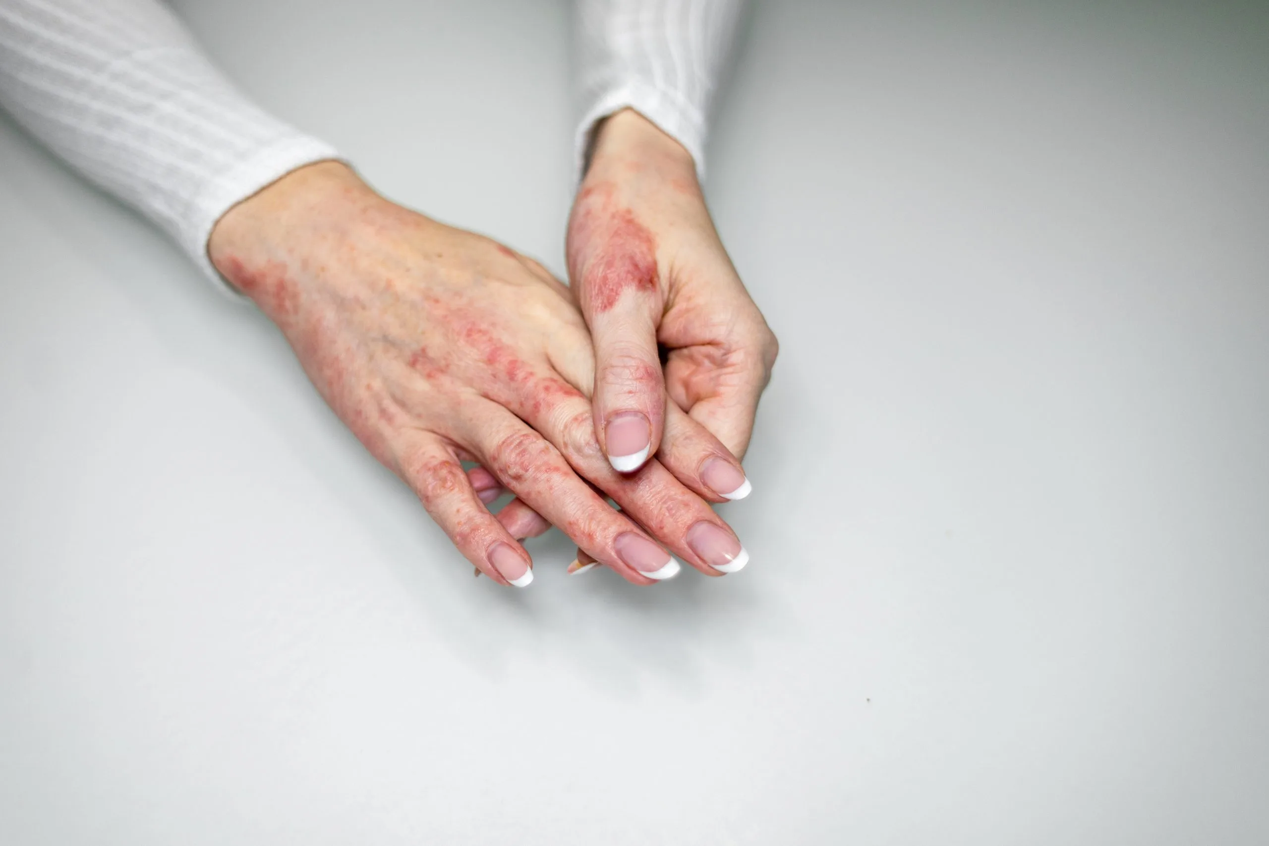 Hands showing red, irritated skin with rash on back and fingers