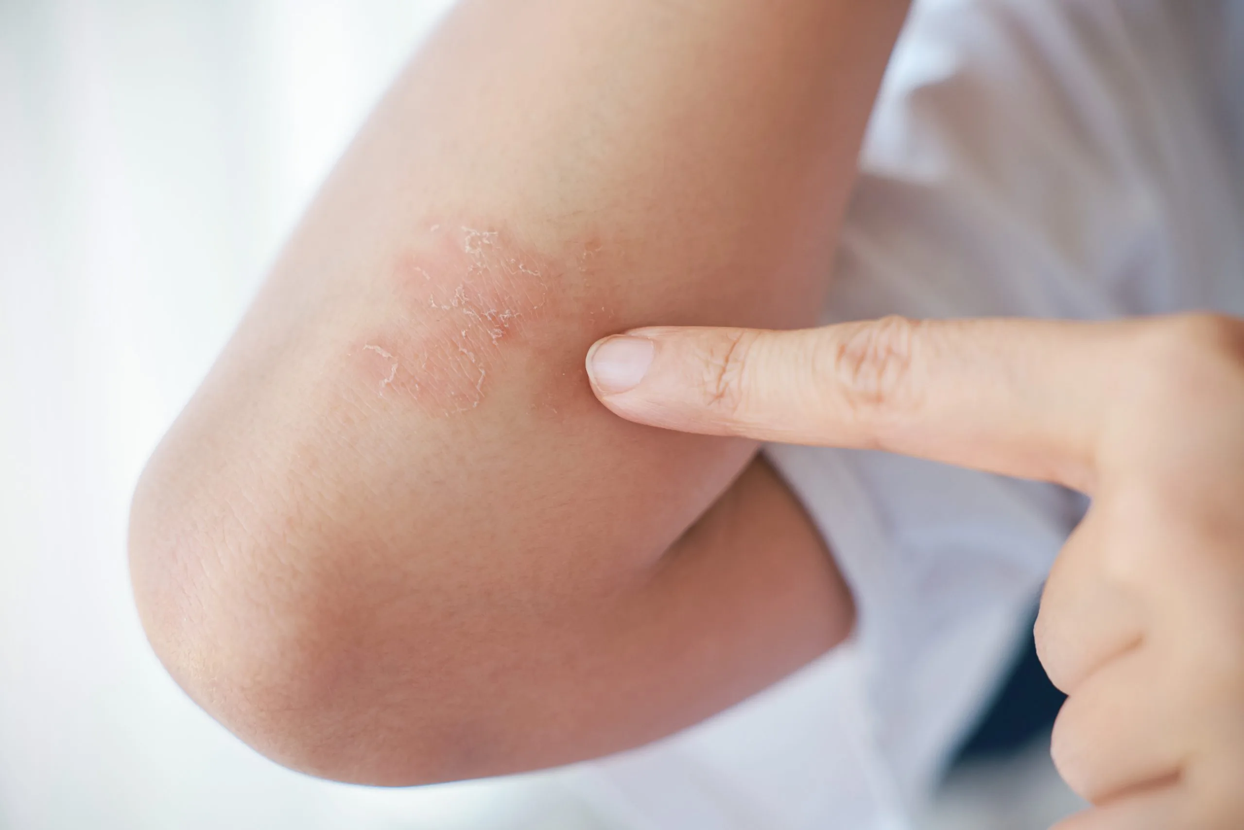 Psoriasis on skin — treatment options discussed by Everoak Dermatology