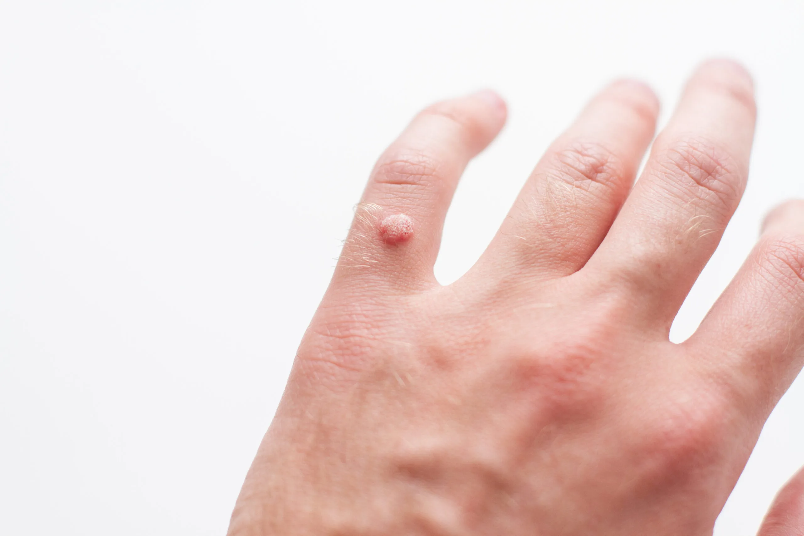 Wart removal in Celina, TX