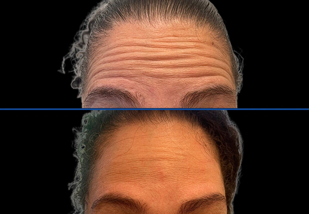 botox4|Exert Clinic
