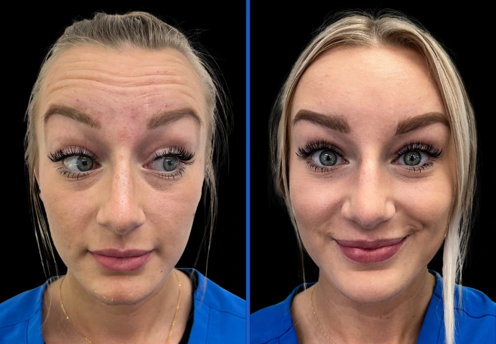 botox|Exert Clinic