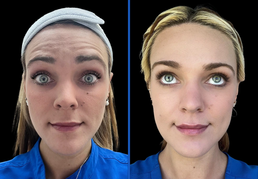 botox1|Exert Clinic