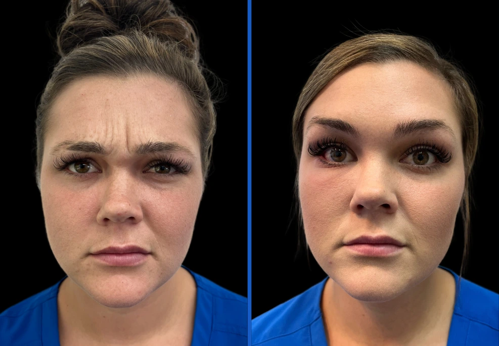 botox4|Exert Clinic
