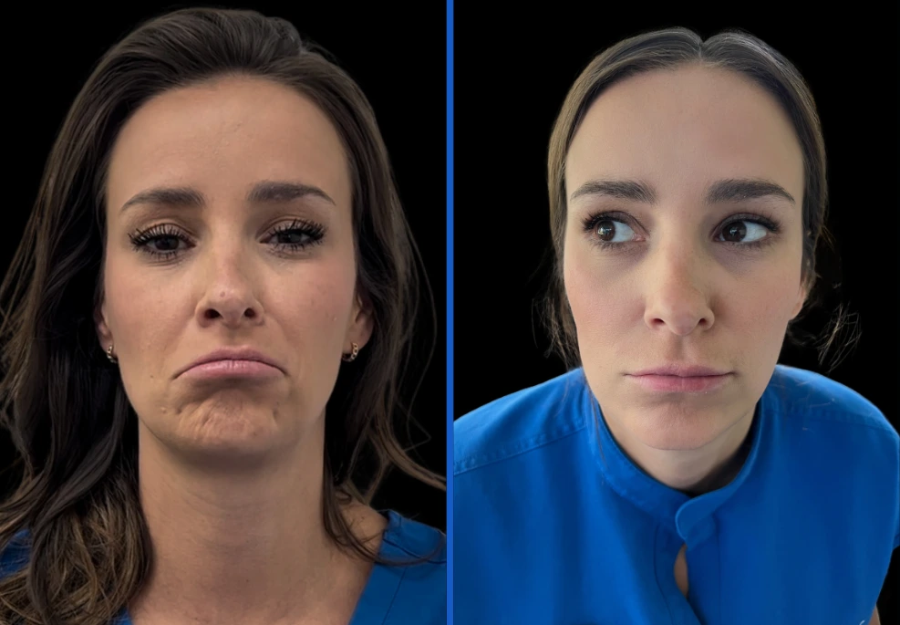 botox6|Exert Clinic