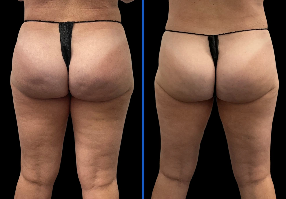 2aveli|Exertclinic
