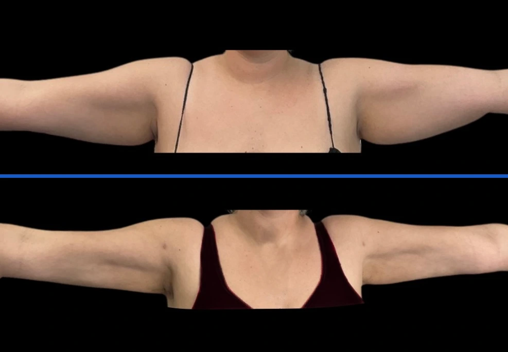 arm1|Exert Clinic