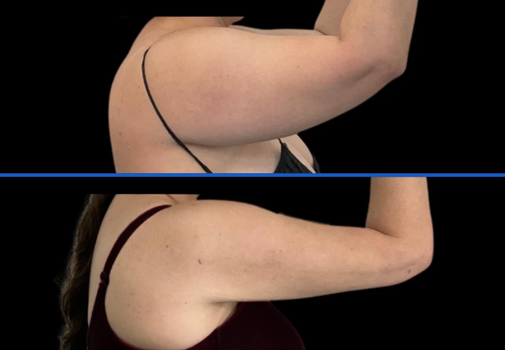 arm4|Exert Clinic