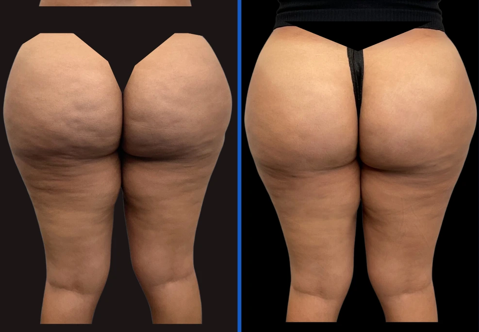 aveli|Exertclinic