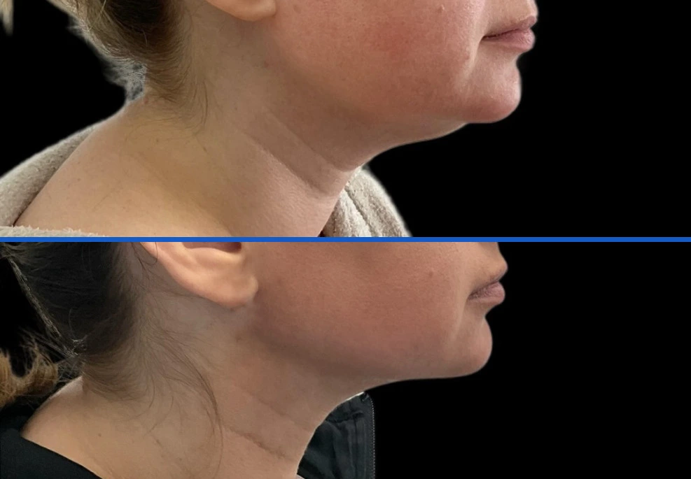 chin |Exert Clinic