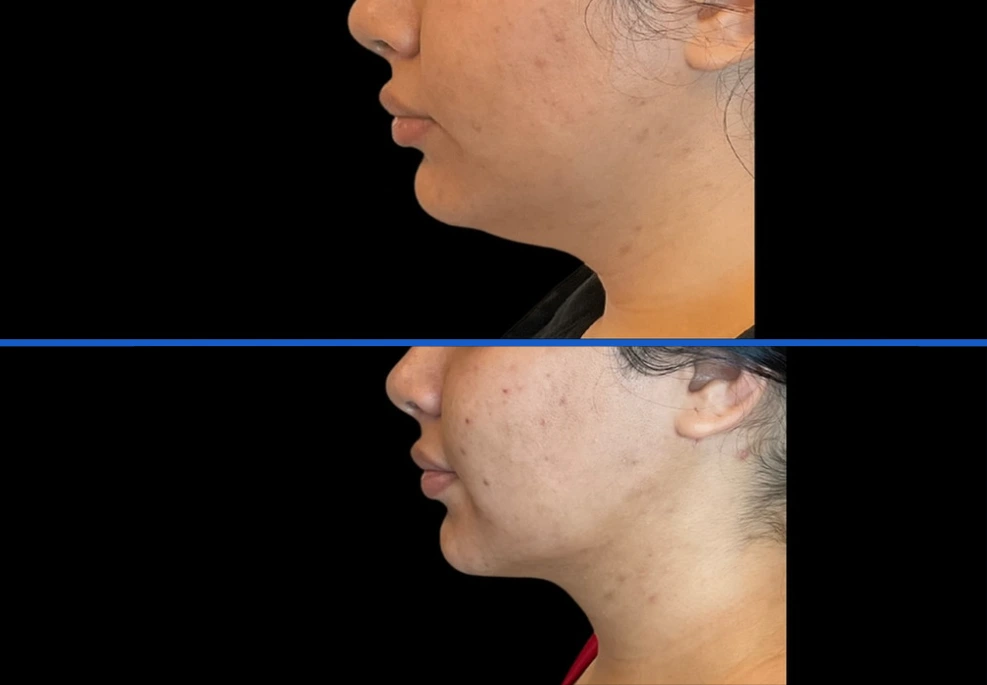 chin|Exert Clinic