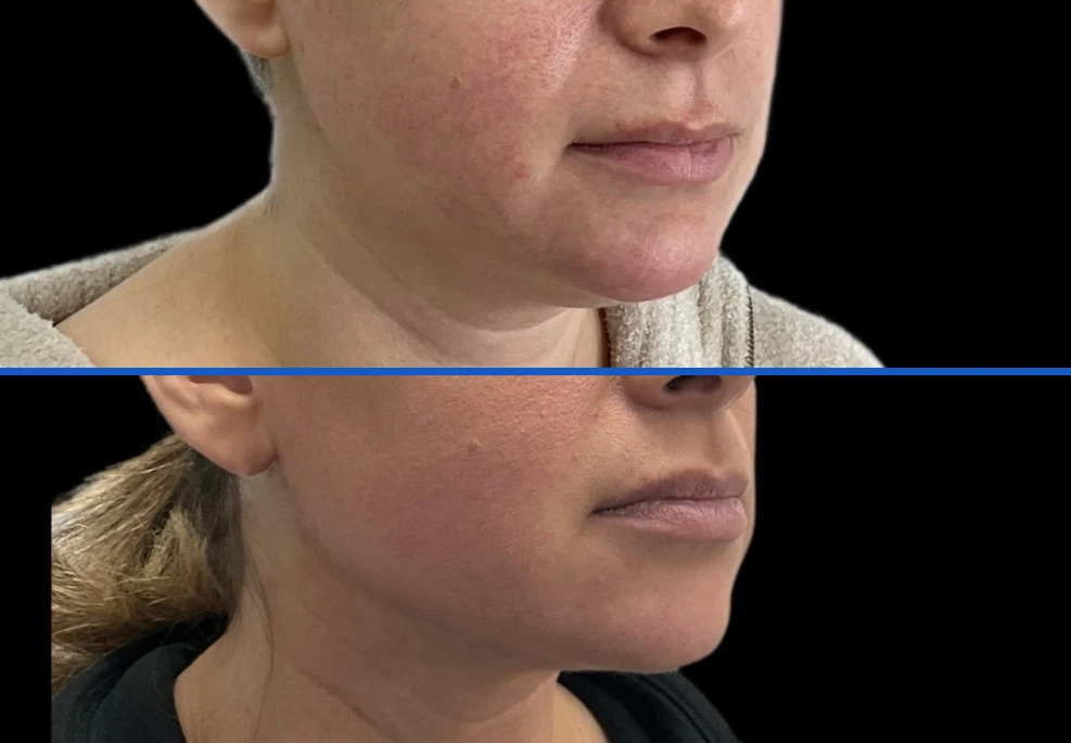 chin1|Exert Clinic