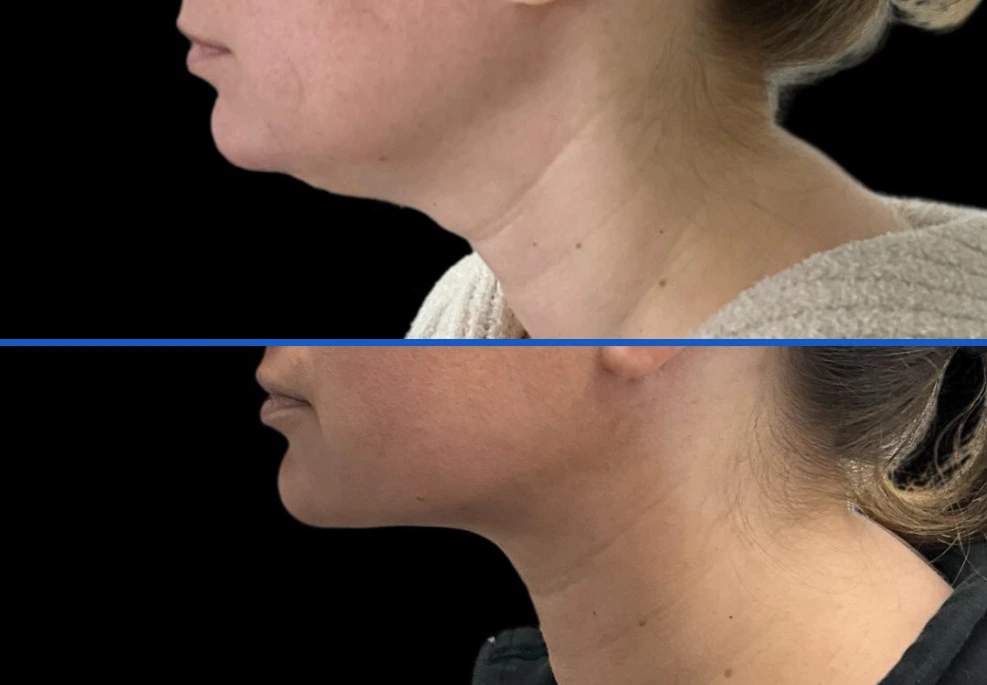 chin2|Exert Clinic