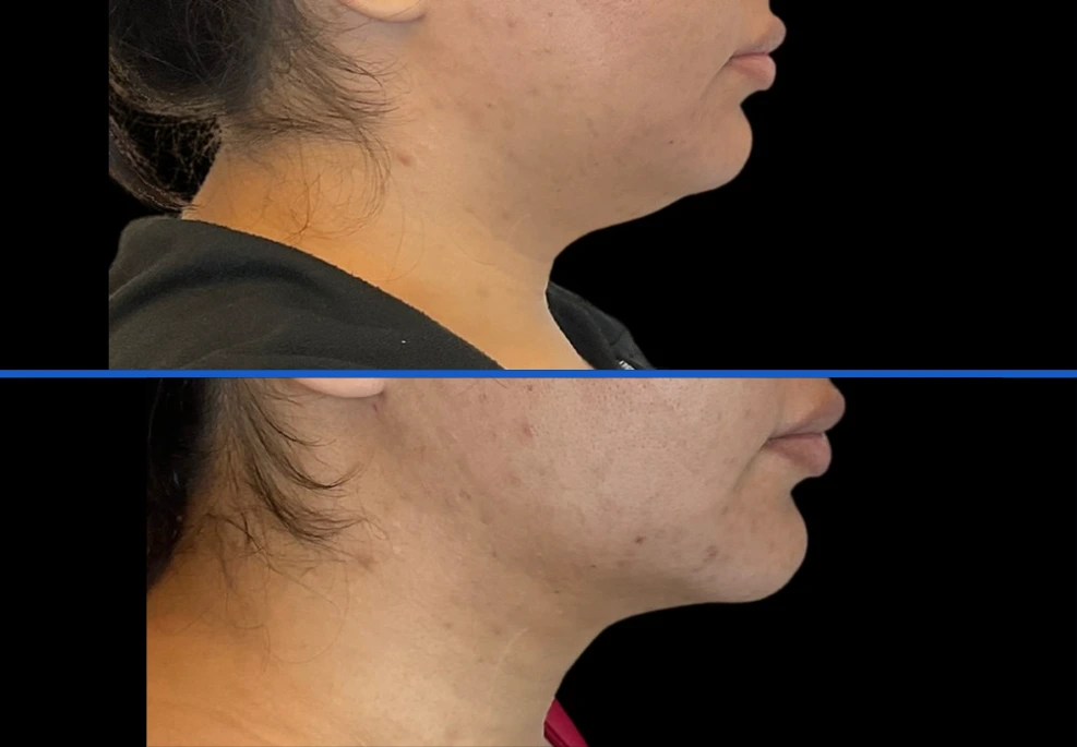 chin2| Exert Clinic