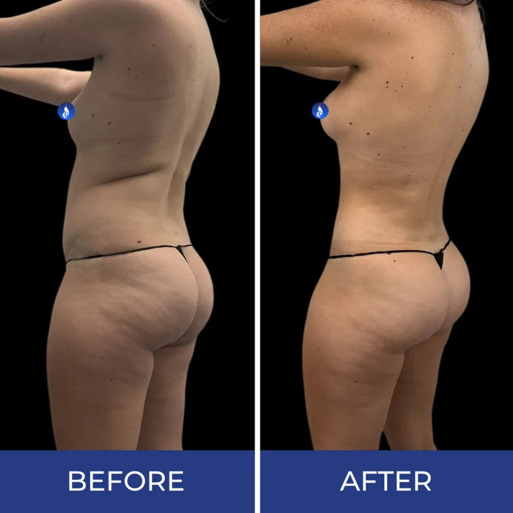 Before and after side view of torso showing reduced midsection softness and improved waist definition