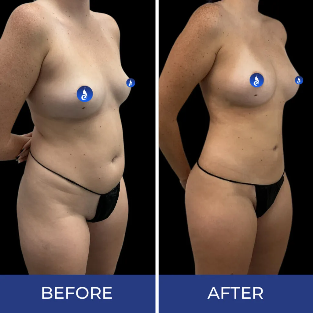 Side-by-side comparison of female torso before and after body sculpting treatment, showing improved breast contour and reduced abdominal fullness