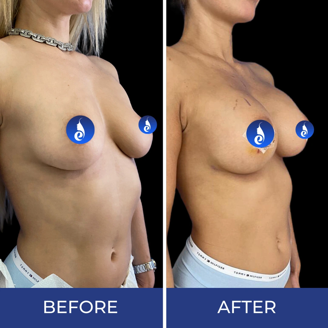 Before and after comparison of breast augmentation results from side angle