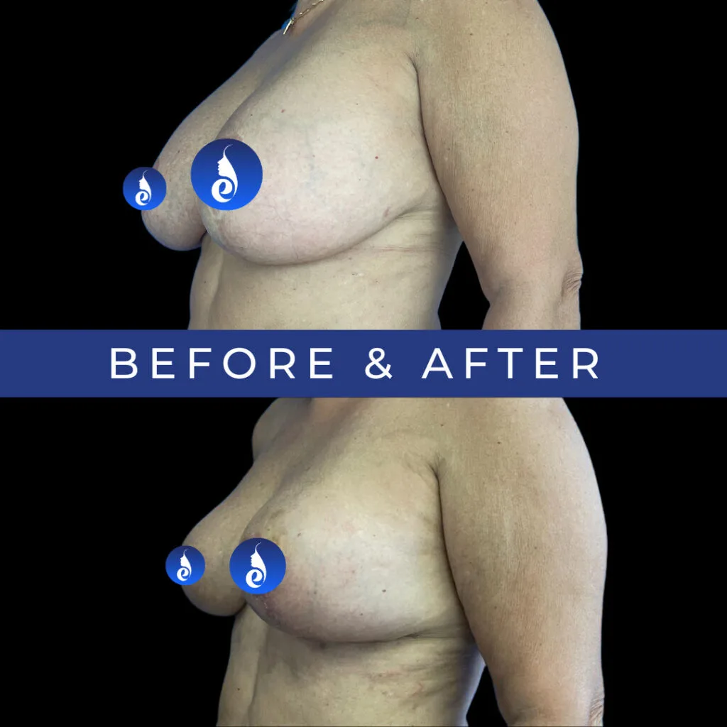 Before and after breast augmentation results, side view