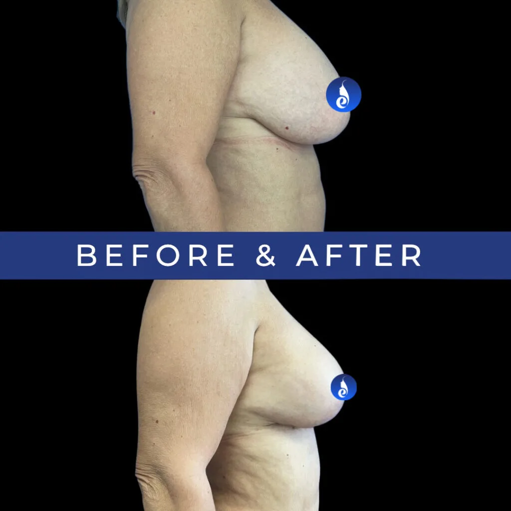 Before and after breast augmentation comparison from side profile angle
