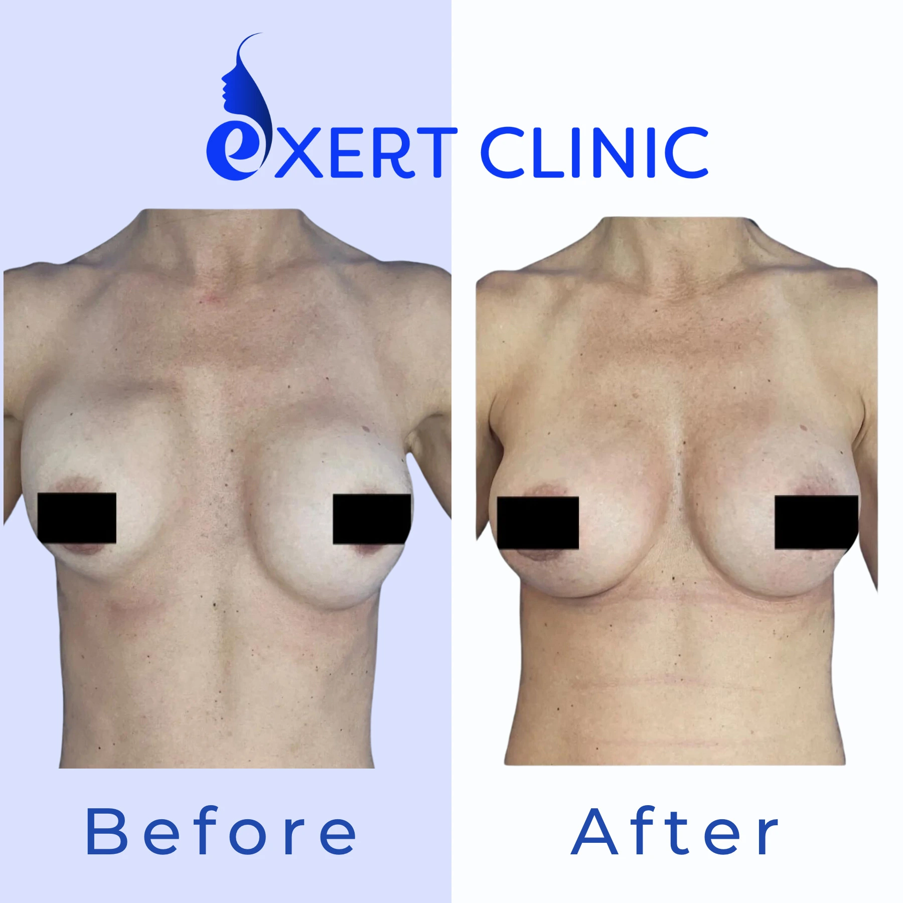 Exert Clinic logo with before and after breast augmentation comparison from front view